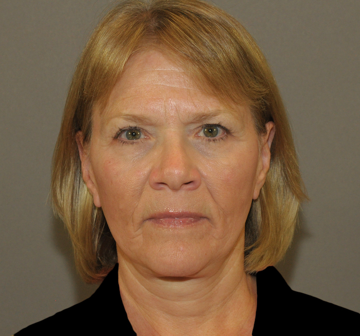 Before and After Photos Mesa Plastic Surgery Gallery Tempe Dr