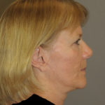 Facelift Before & After Patient #12313