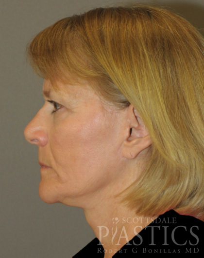 Facelift Before & After Patient #12313