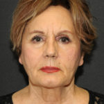 Facelift Before & After Patient #12324