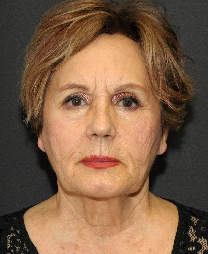 Facelift Before & After Patient #12324