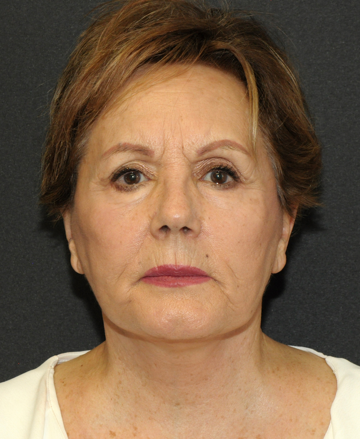 Facelift Before & After Patient #12324