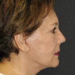 Facelift Before & After Patient #12324