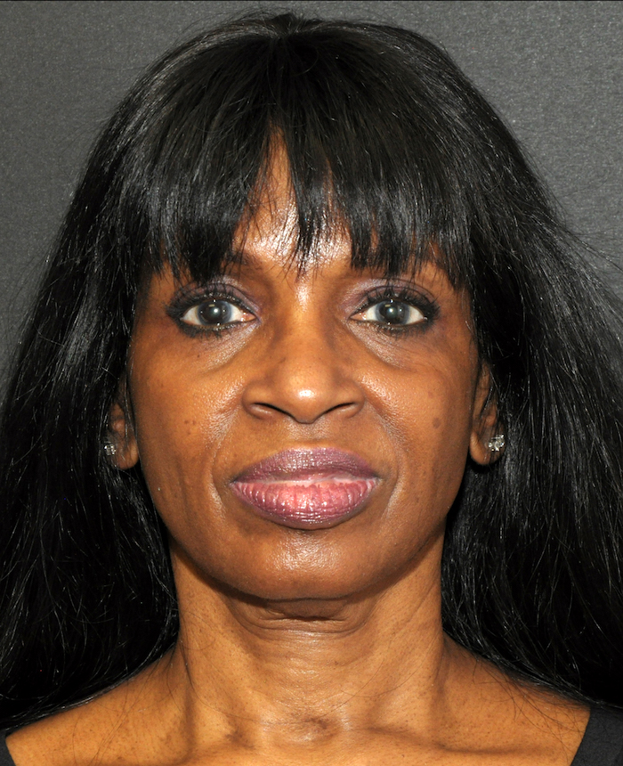 Facelift Before & After Patient #12335