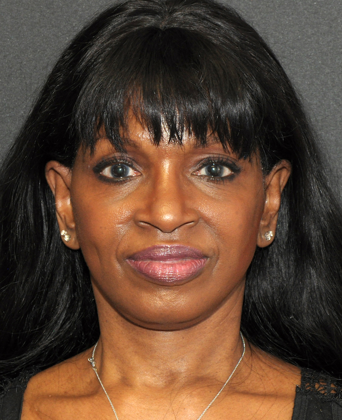 Before and After Photos Mesa Plastic Surgery Gallery Tempe Dr