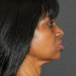 Facelift Before & After Patient #12335
