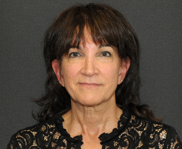 Before and After Photos Mesa Plastic Surgery Gallery Tempe Dr