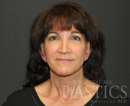 Facelift Before & After Patient #12346