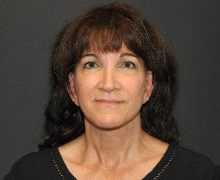 Before and After Photos Mesa Plastic Surgery Gallery Tempe Dr