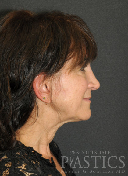 Facelift Before & After Patient #12346