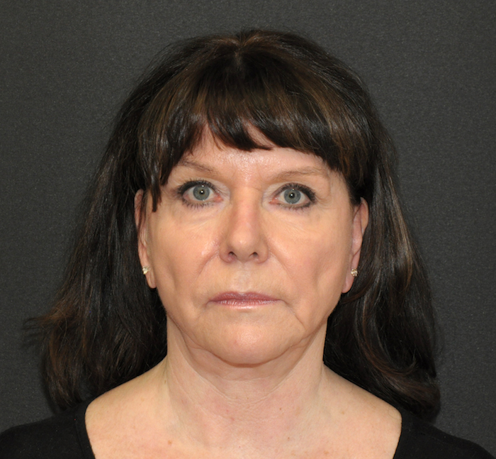 Facelift Before & After Patient #12357