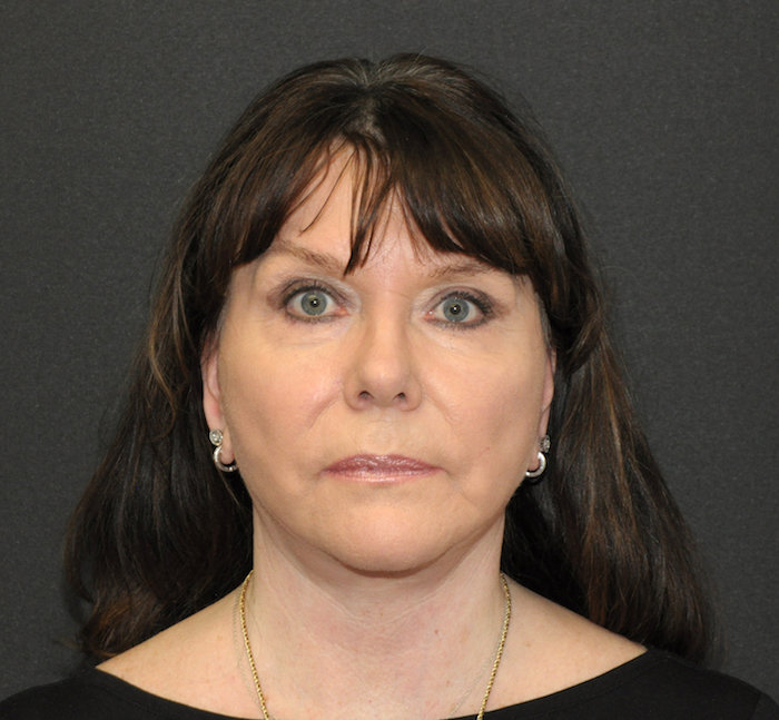 Before and After Photos Mesa Plastic Surgery Gallery Tempe Dr