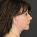 Facelift Before & After Patient #12357