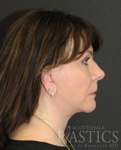 Facelift Before & After Patient #12357