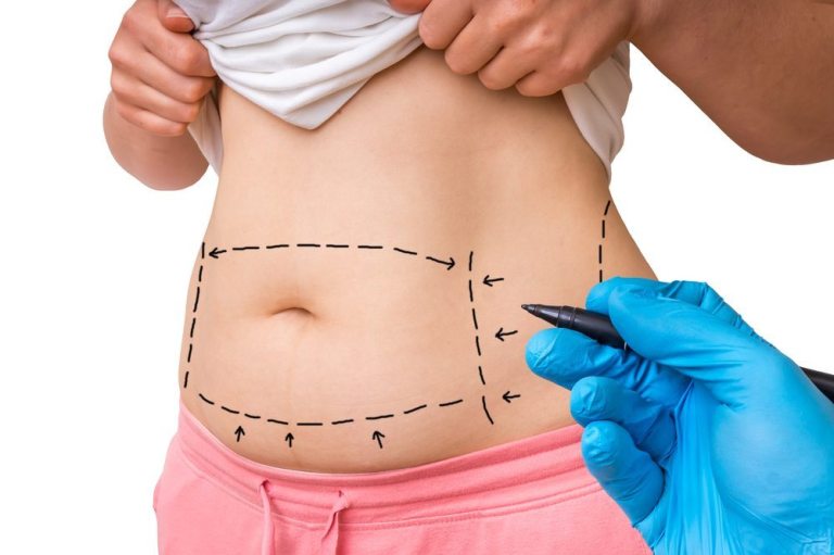 5 Unexpected Benefits of a Tummy Tuck in Scottsdale, AZ