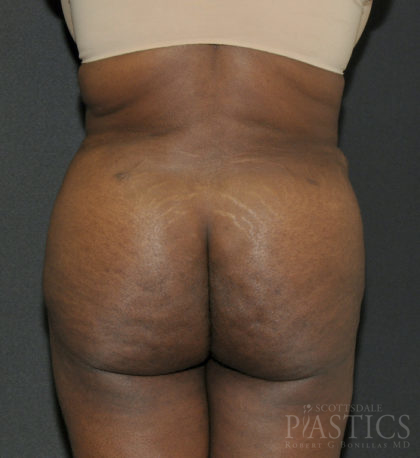 Butt Augmentation Before & After Patient #12534
