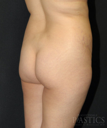 Butt Augmentation Before & After Patient #12541