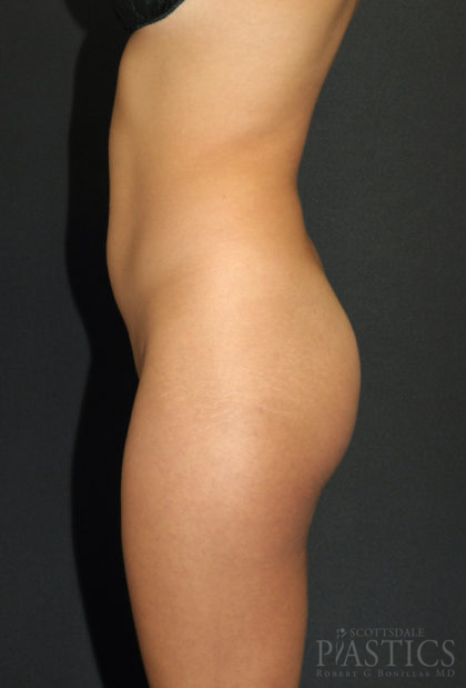 Butt Augmentation Before & After Patient #12552