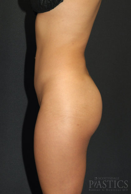 Butt Augmentation Before & After Patient #12552