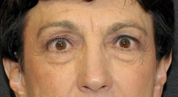 Blepharoplasty Before & After Patient #12387