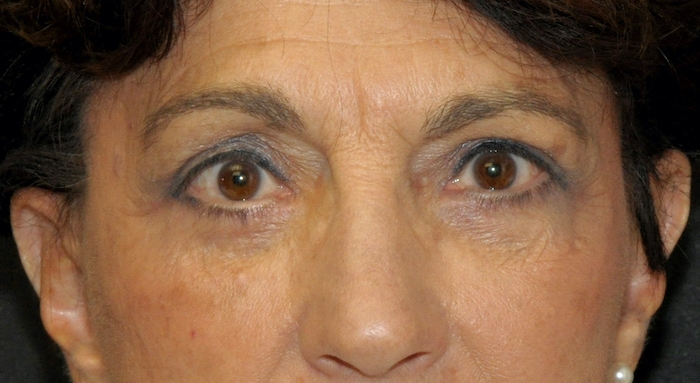 Blepharoplasty Before & After Patient #12387