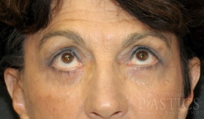 Blepharoplasty Before & After Patient #12387
