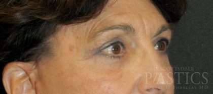 Blepharoplasty Before & After Patient #12387