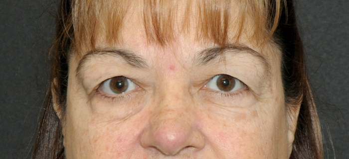 Blepharoplasty Before & After Patient #12396