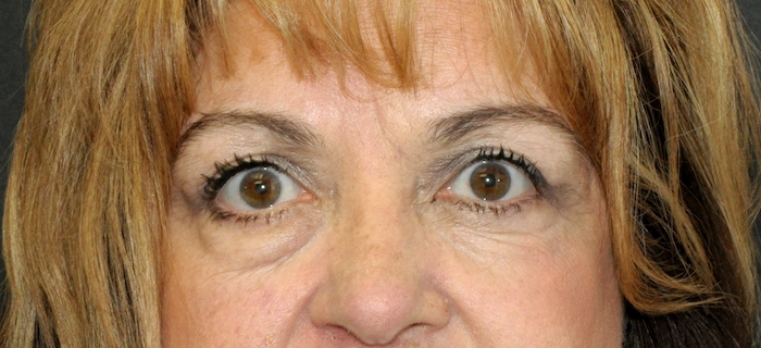 Blepharoplasty Before & After Patient #12396
