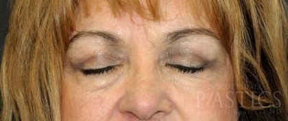 Blepharoplasty Before & After Patient #12396