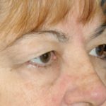 Blepharoplasty Before & After Patient #12396