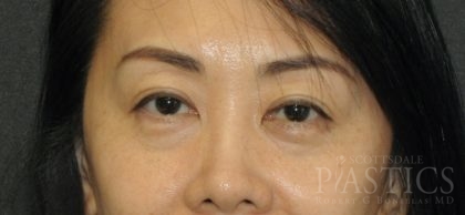 Blepharoplasty Before & After Patient #12405