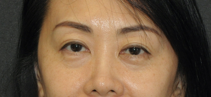 Blepharoplasty Before & After Patient #12405