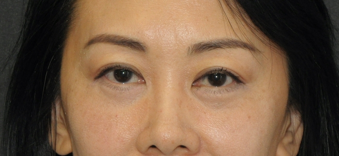 Blepharoplasty Before & After Patient #12405