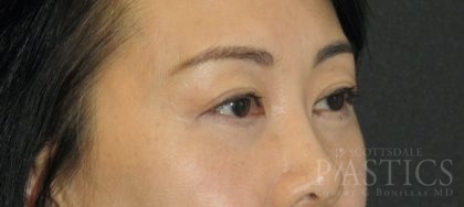 Blepharoplasty Before & After Patient #12405