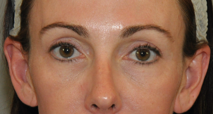Blepharoplasty Before & After Patient #12414