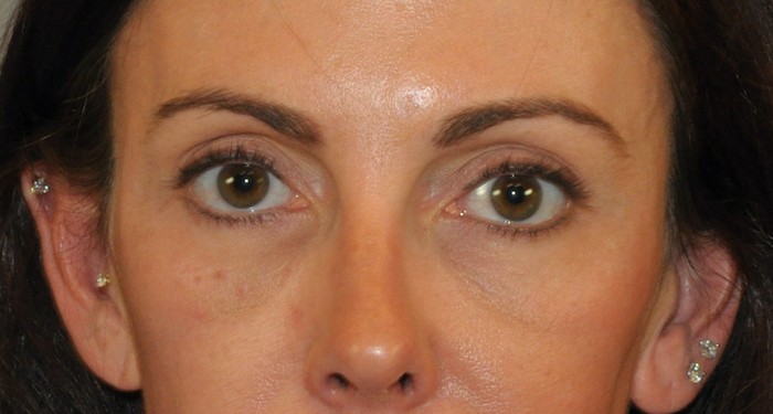 Blepharoplasty Before & After Patient #12414