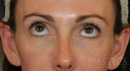 Blepharoplasty Before & After Patient #12414