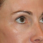 Blepharoplasty Before & After Patient #12414