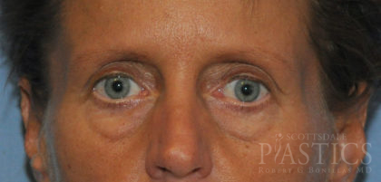 Blepharoplasty Before & After Patient #12424