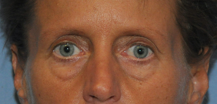 Blepharoplasty Before & After Patient #12424