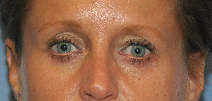 Blepharoplasty Before & After Patient #12424