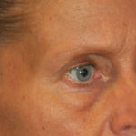 Blepharoplasty Before & After Patient #12424