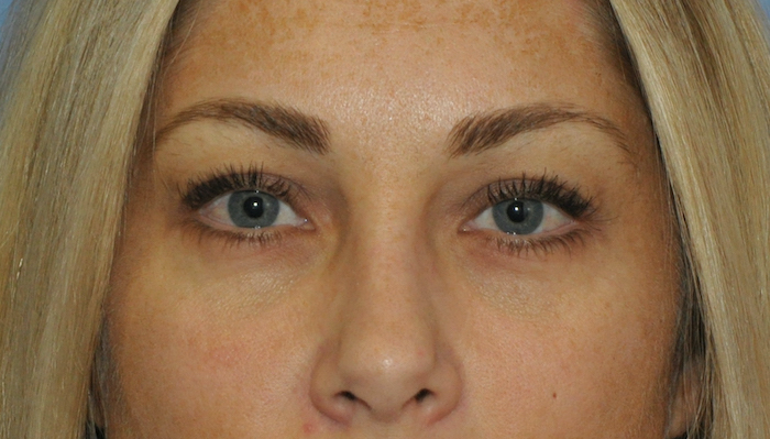 Blepharoplasty Before & After Patient #12431