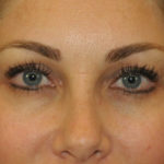 Blepharoplasty Before & After Patient #12431