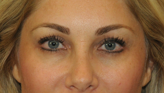 Blepharoplasty Before & After Patient #12431