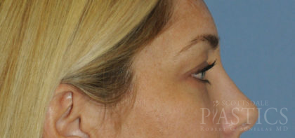 Blepharoplasty Before & After Patient #12431