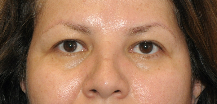 Blepharoplasty Before & After Patient #12438