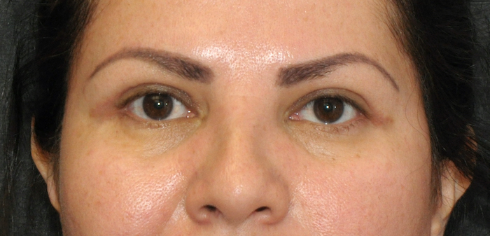 Blepharoplasty Before & After Patient #12438
