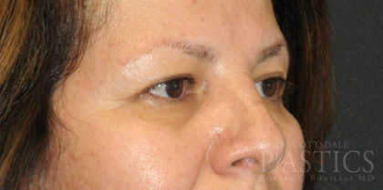 Blepharoplasty Before & After Patient #12438